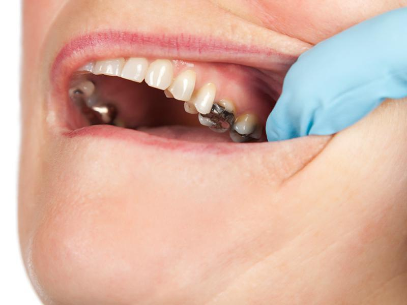 How Much Does a Dental Filling Cost? - Explained
