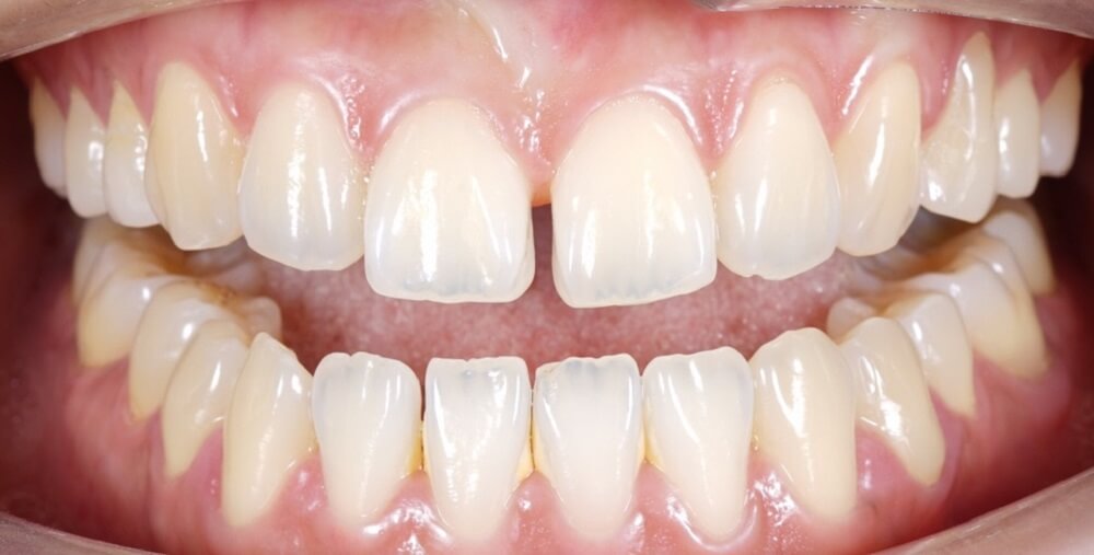 DIY Tooth Bonding @ home dental care. Save Money! 