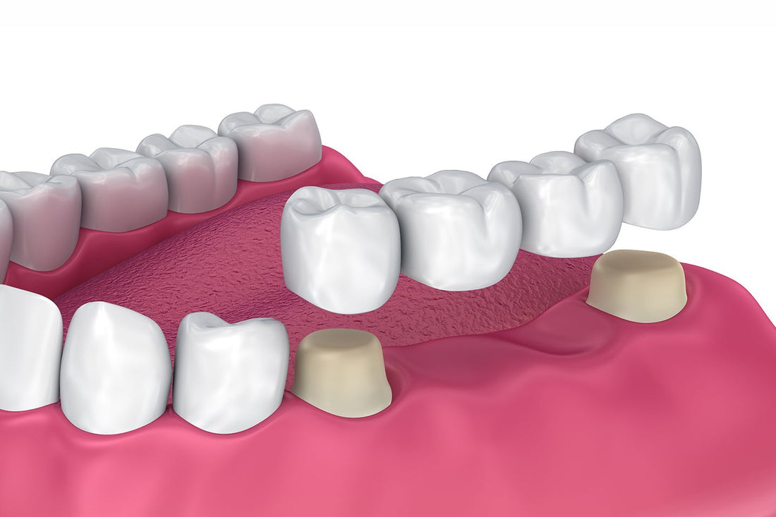Dental Bridges Types