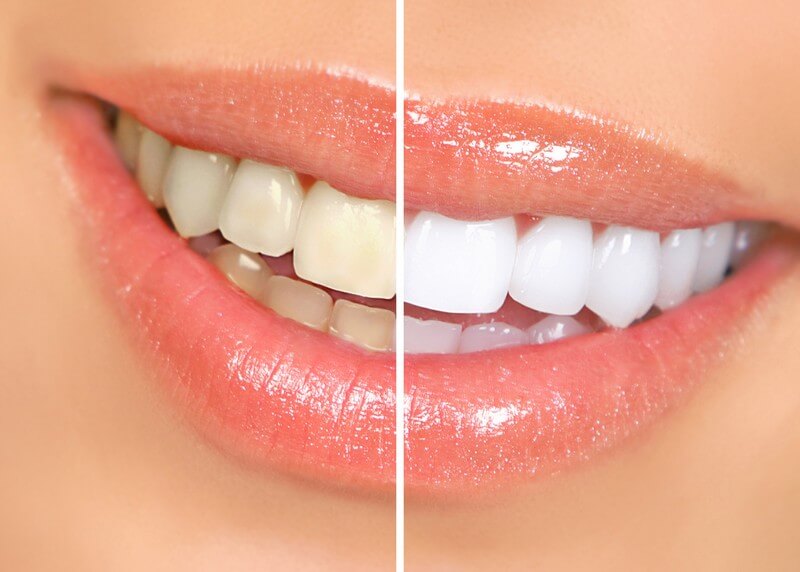 Best Way to Whiten Sensitive Teeth