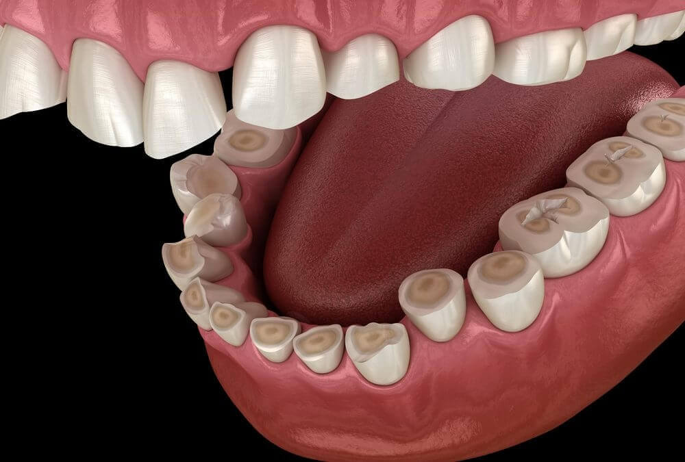 Tooth Enamel Erosion