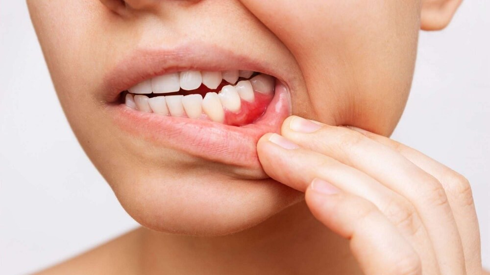 Why are My Gums Bleeding When Flossing?
