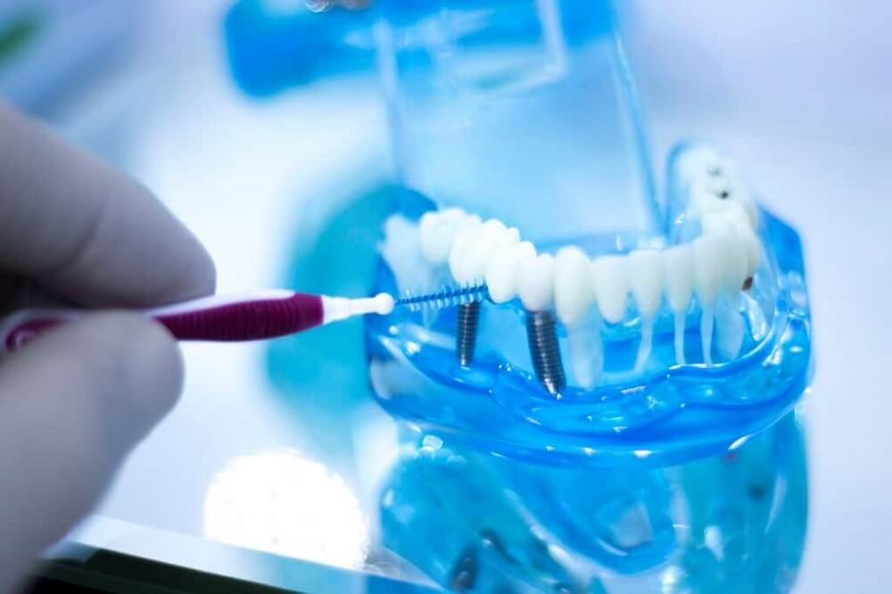 How to care for Dental Implants