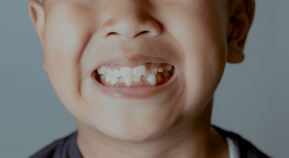 Hyperdontia Teeth: Can Hyperdontia Teeth be Removed?