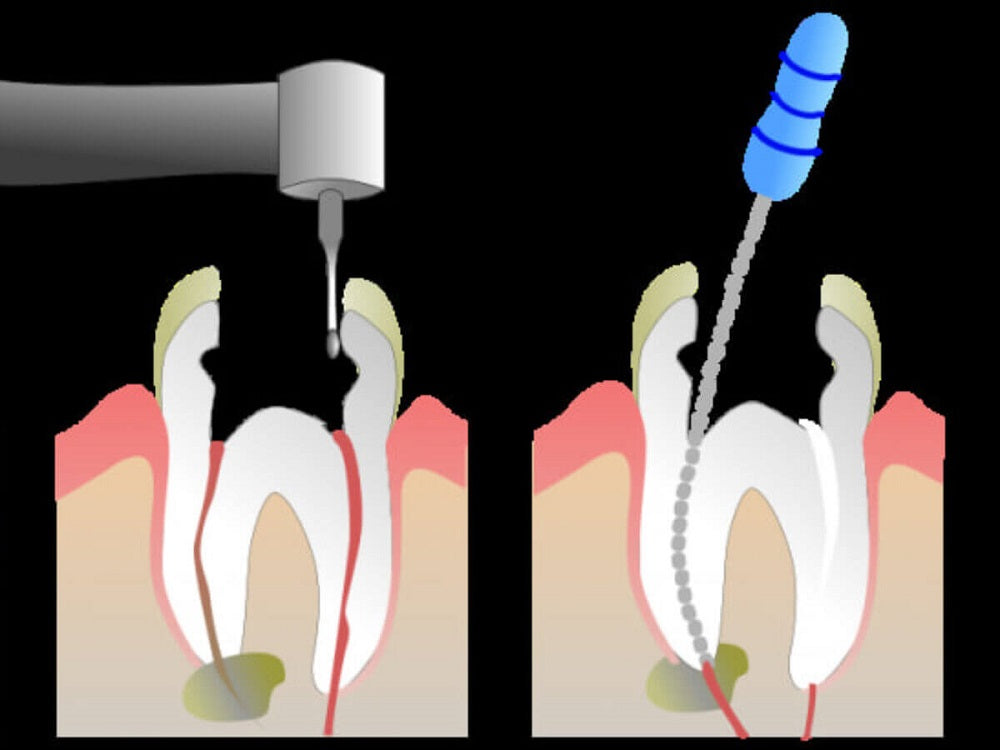 Persistent Abscess: Symptoms of Jaw Infection After Root Canal