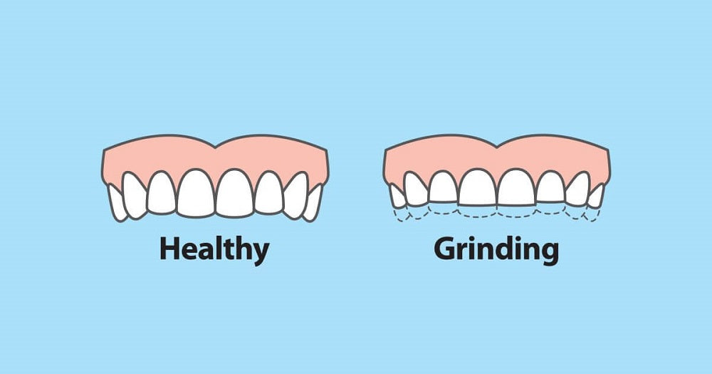 What is Teeth Grinding and How Long Does Teeth Grinding Pain Last?