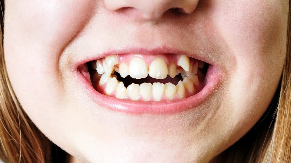 What Causes Crooked Teeth
