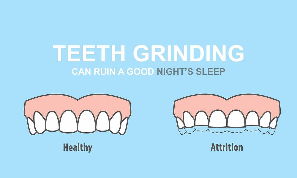 What Causes Teeth Grinding