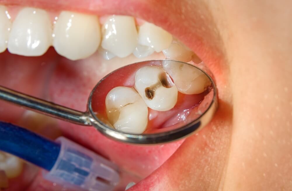 What Do Cavities Look Like - How Can You Avoid Them Easily?