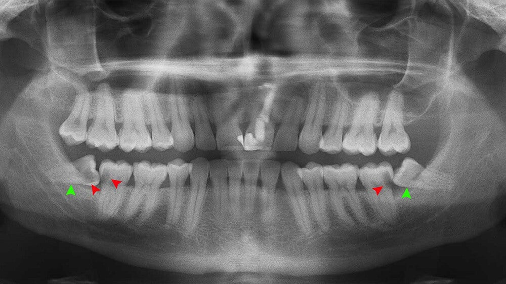 What are Impacted Wisdom Teeth