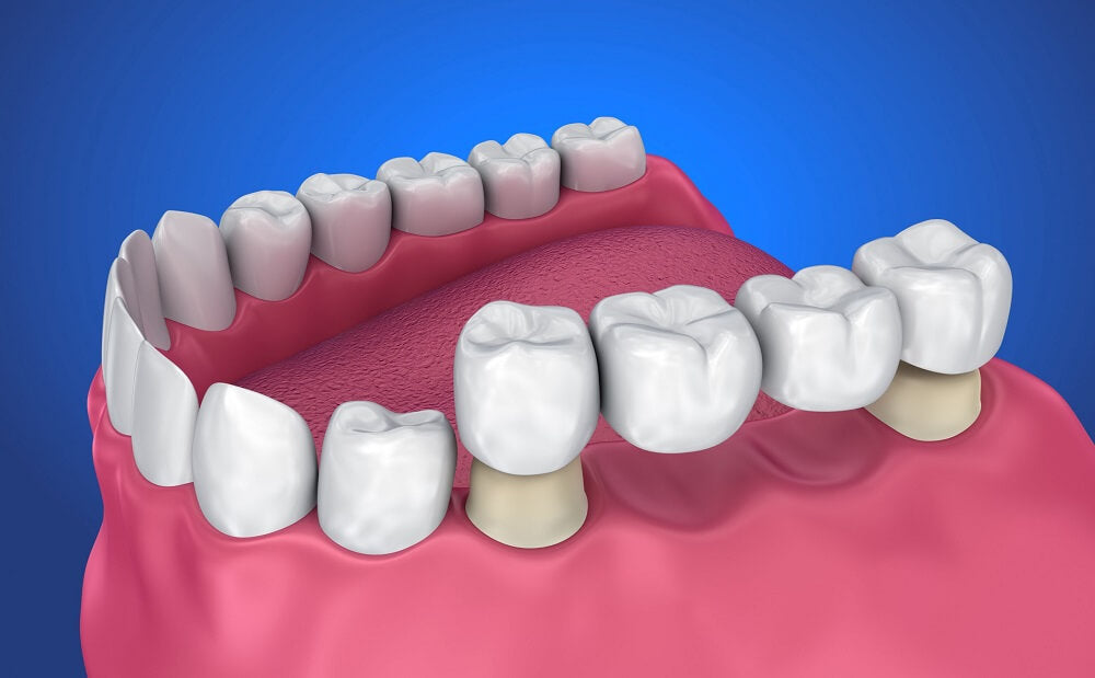 What is a Dental Bridge