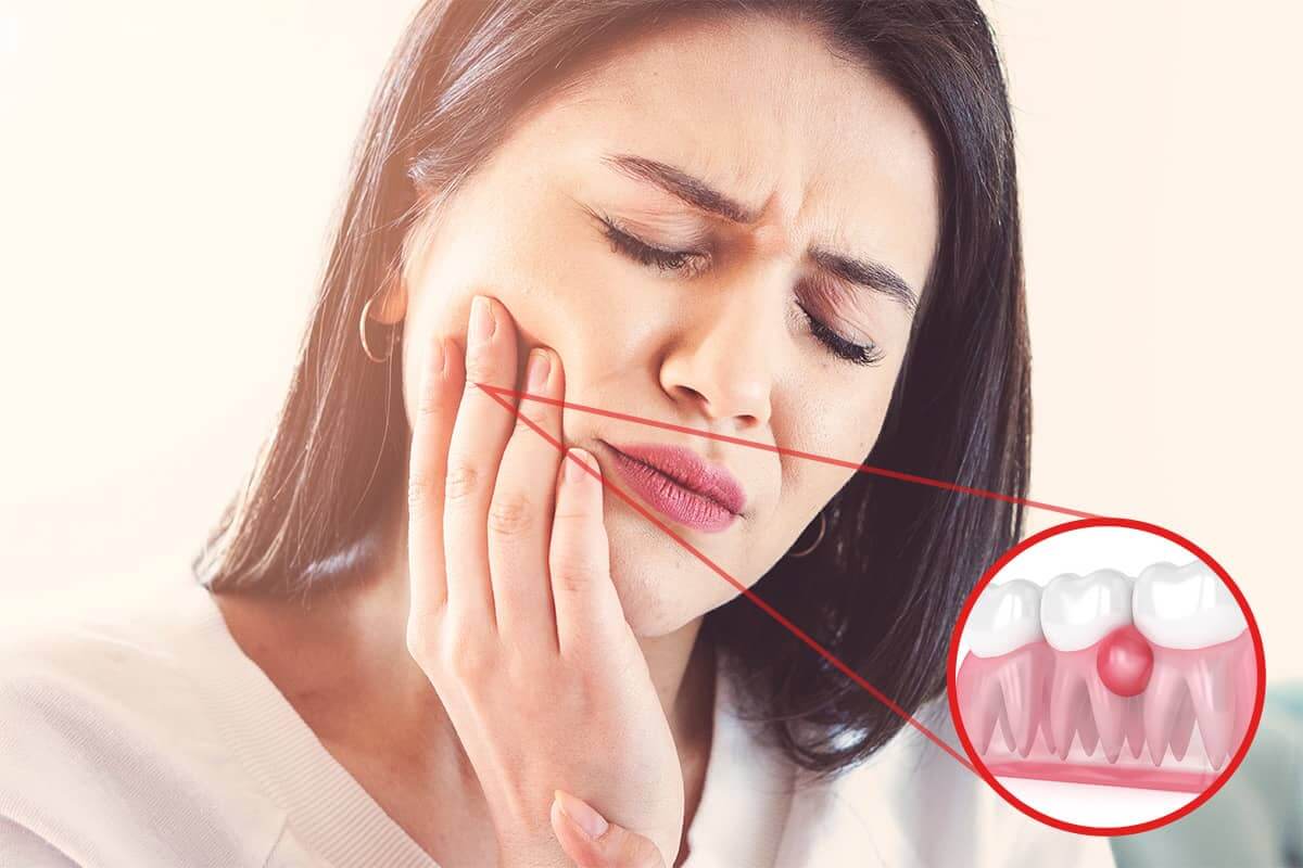 What to Do If a Dental Abscess Bursts On Its Own