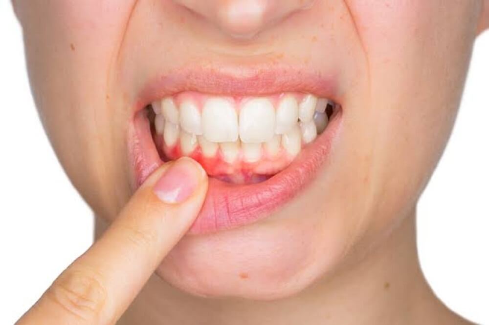 How Long Do Gum Infections Last?