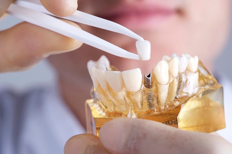 How Long Do Dental Implants Last? Are Dental Implants Better than Dental Bridges, Dentures, and Crowns?