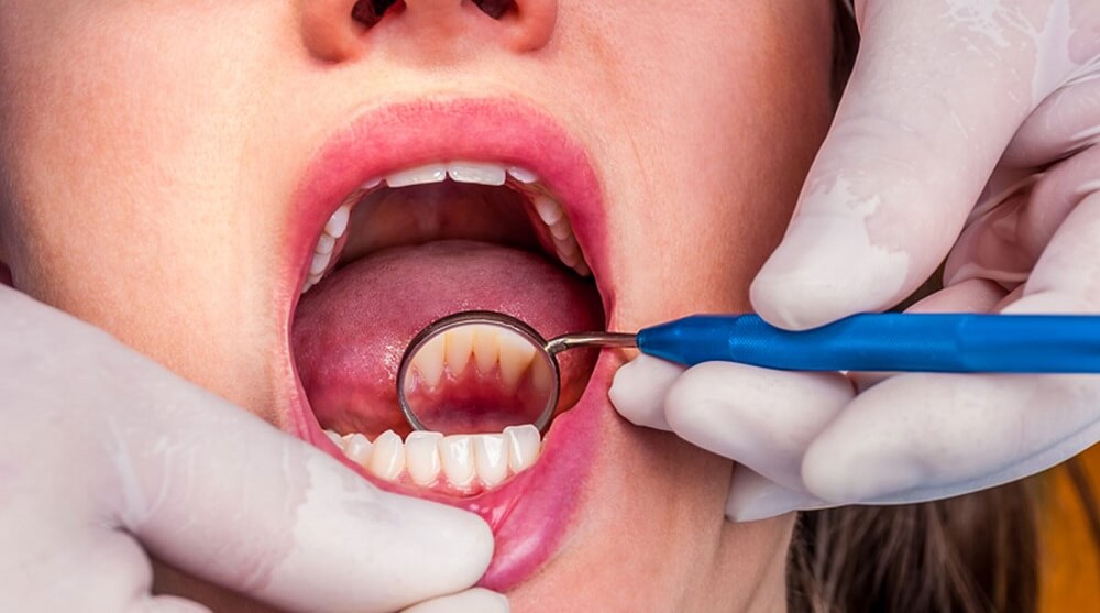 Dental Cleanings: How Long Does a Dental Cleaning Take?