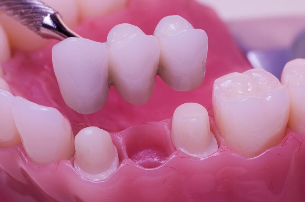 How Much is a Dental Bridge - Are They Expensive?