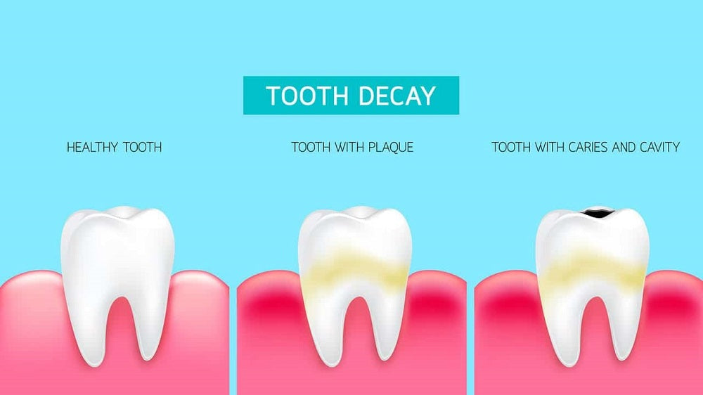 What Does Tooth Decay Look Like