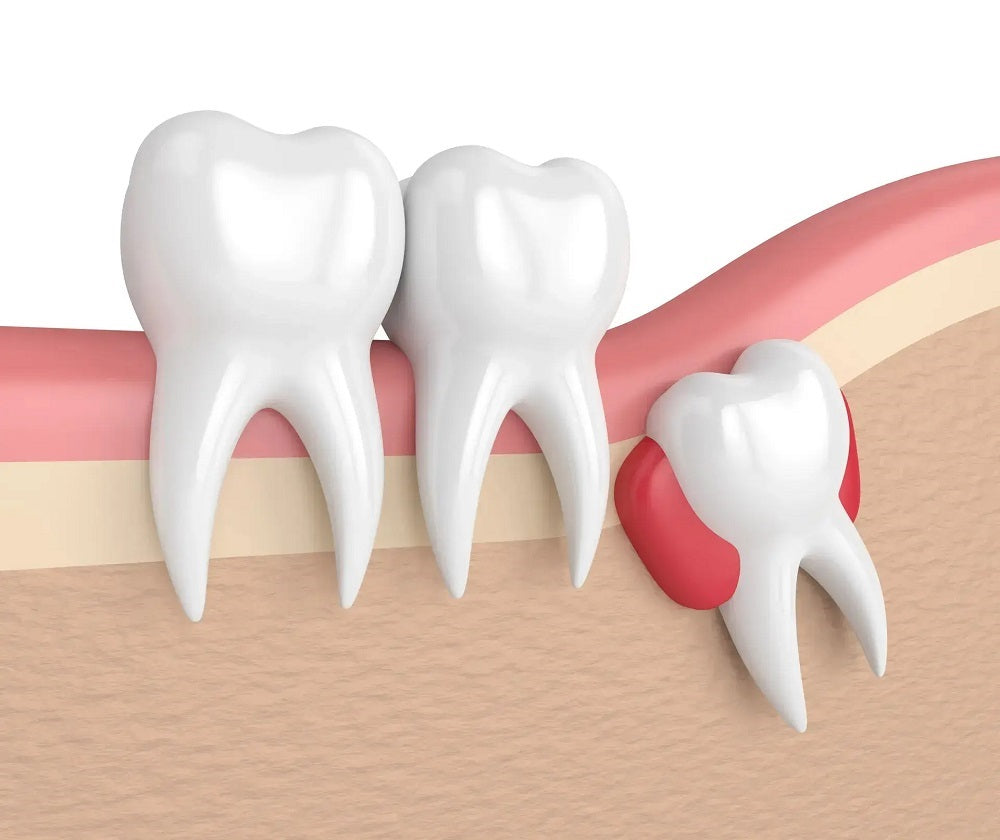 wisdom tooth is impacted – symptoms & preventions 